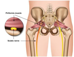 SCIATICA & CERVICAL SPONDYLOSIS